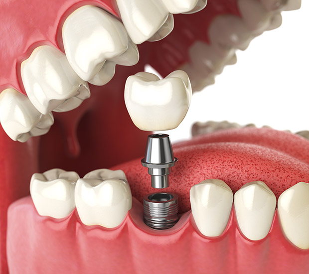 Burbank Will I Need a Bone Graft for Dental Implants