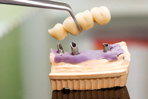 Are There Different Types Of Dental Bridges?