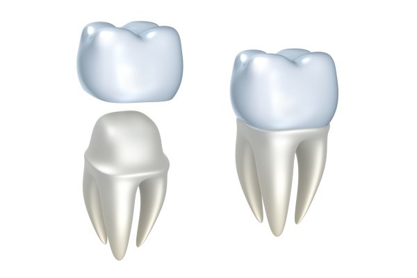 The Different Types Of Dental Crowns