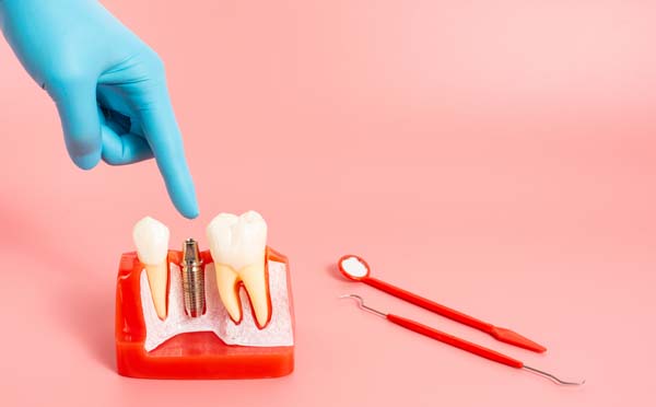 A Procedure Guide To Getting A Dental Implant