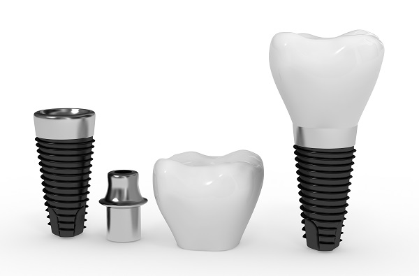 Dental Implants Burbank, CA