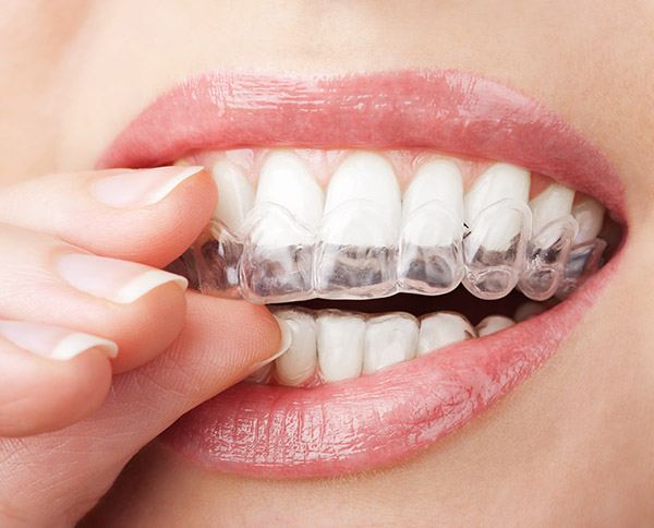 Tips For Getting The Most Out Of Invisalign