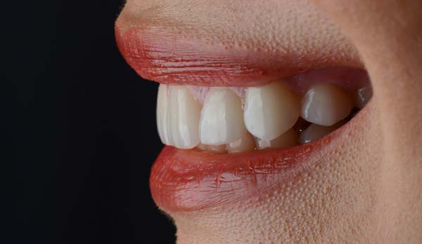 A Smile Makeover Can Improve Discolored Teeth