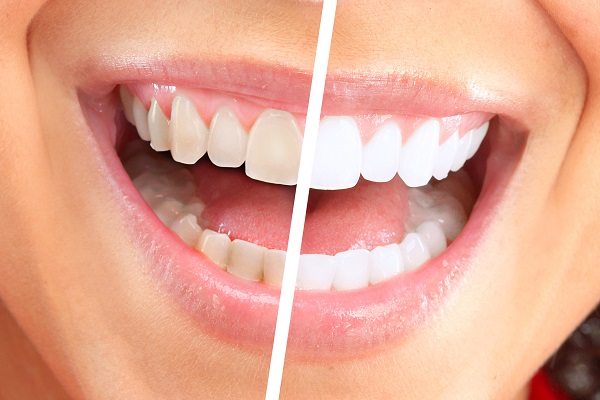 Tips To Make In Office Teeth Whitening Last